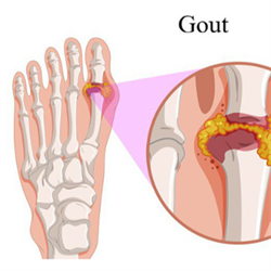 Bệnh Gout